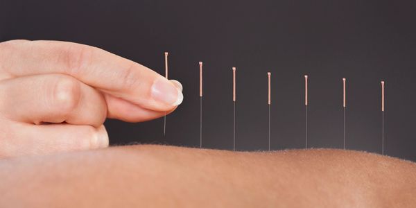 Dry Needling